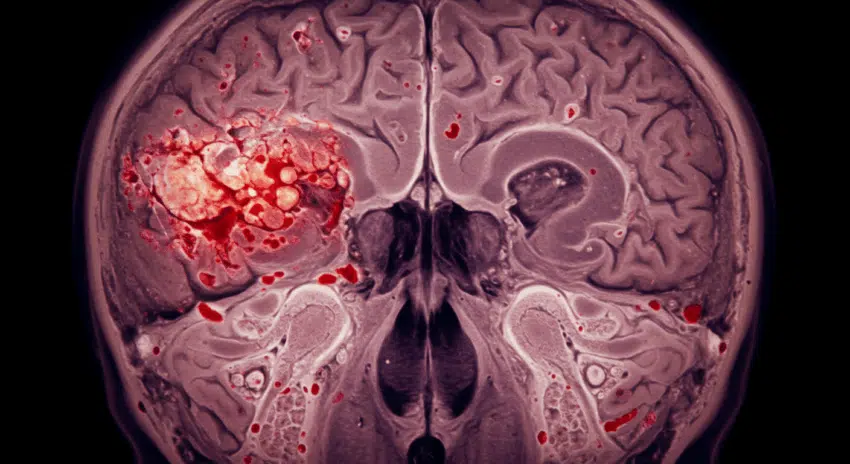 Types of Traumatic Brain And Head Injuries