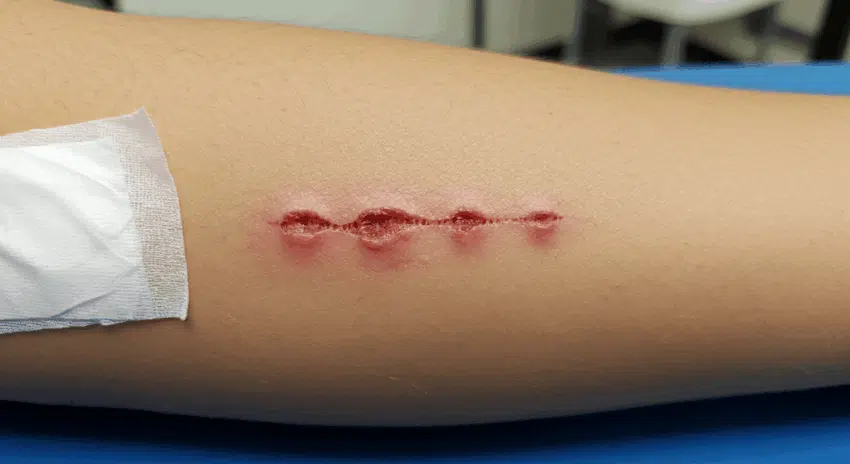 Dog Bite Injury Claims